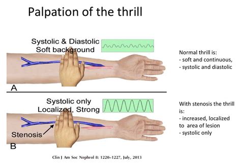 bruit and thrill assessment charting.